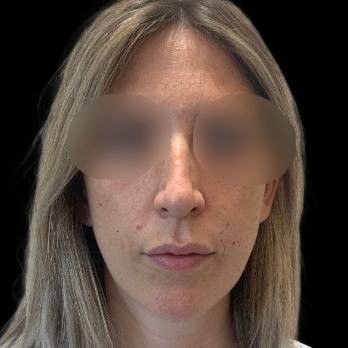 preservation-rhinoplasty-before